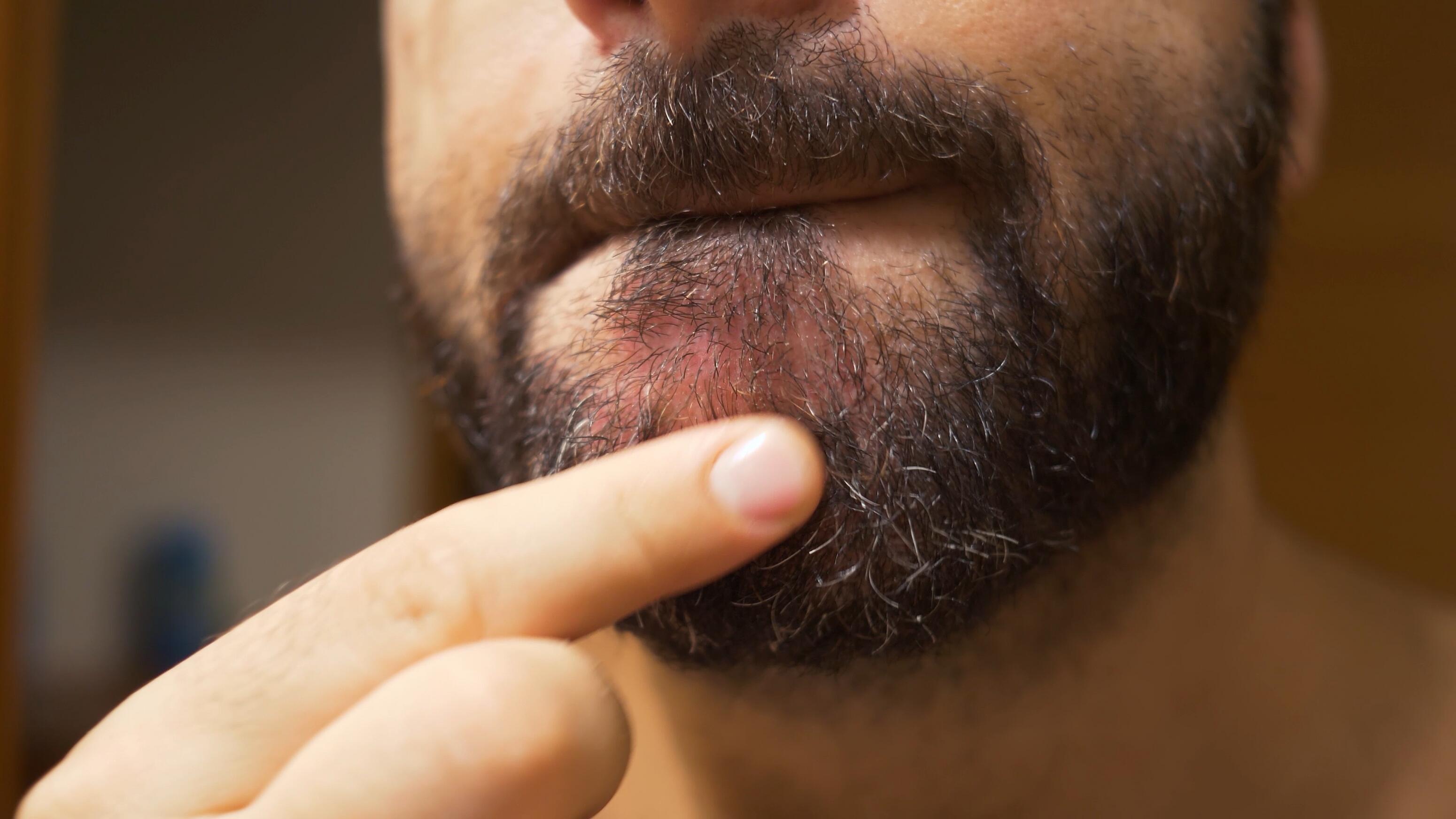 Symptôme des pellicules de barbe